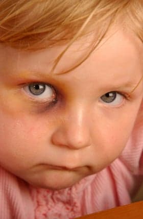 little girl with black eye